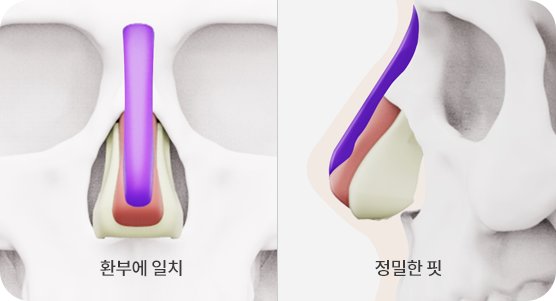 FITme implant: matches the area, precise fit