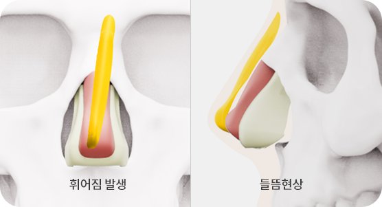 Standard implant: bending and lifting