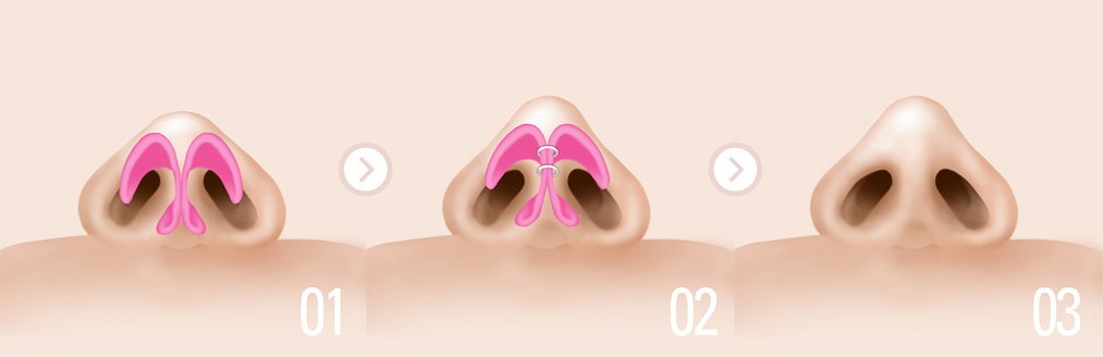 코끝을 조금 높이는 경우 — 1·2·3단계 그림