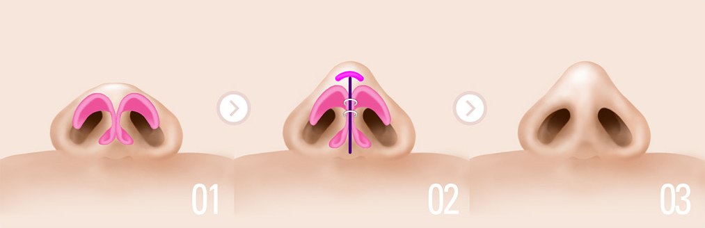 코끝을 많이 높이는 경우 — 1·2·3단계 그림
