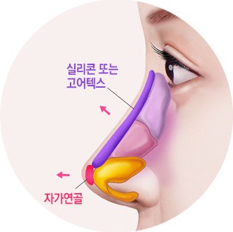 낮은코 수술방법 그림 2단계