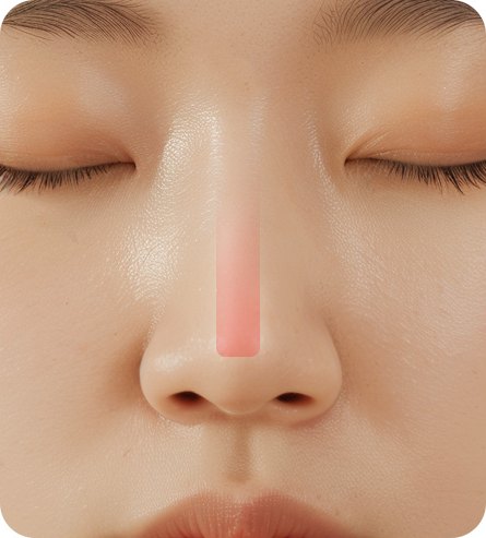 코재건술 CASE 08 — 보형물이 비춰 보이는 경우
