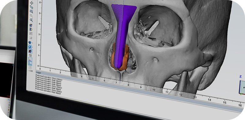 3D-CT 데이터로 코 보형물을 설계하는 화면