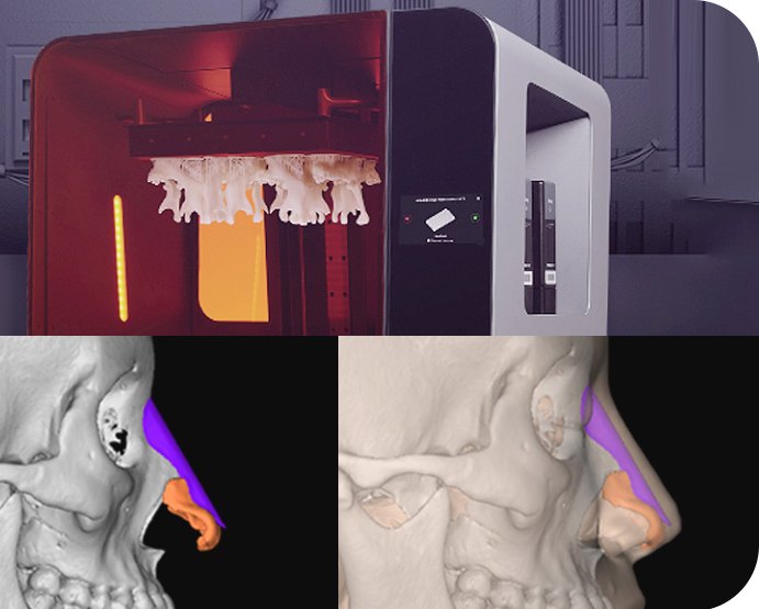 3D 프린터로 제작하는 맞춤 보형물과 CT 시뮬레이션